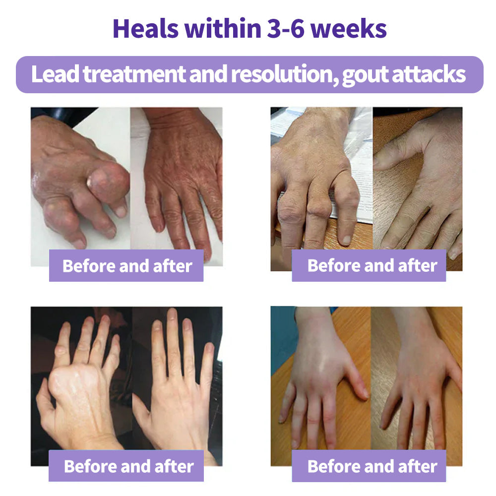 ⏰Black Friday Limited-Time Special Offer: BUY 1 GET 1 FREE🔥Lovilds™ Turmeric & Emu Oil Arthritis Soothing Pain Relief Massage Gel 👨‍⚕️ American Osteopathic Association (AOA) Approved